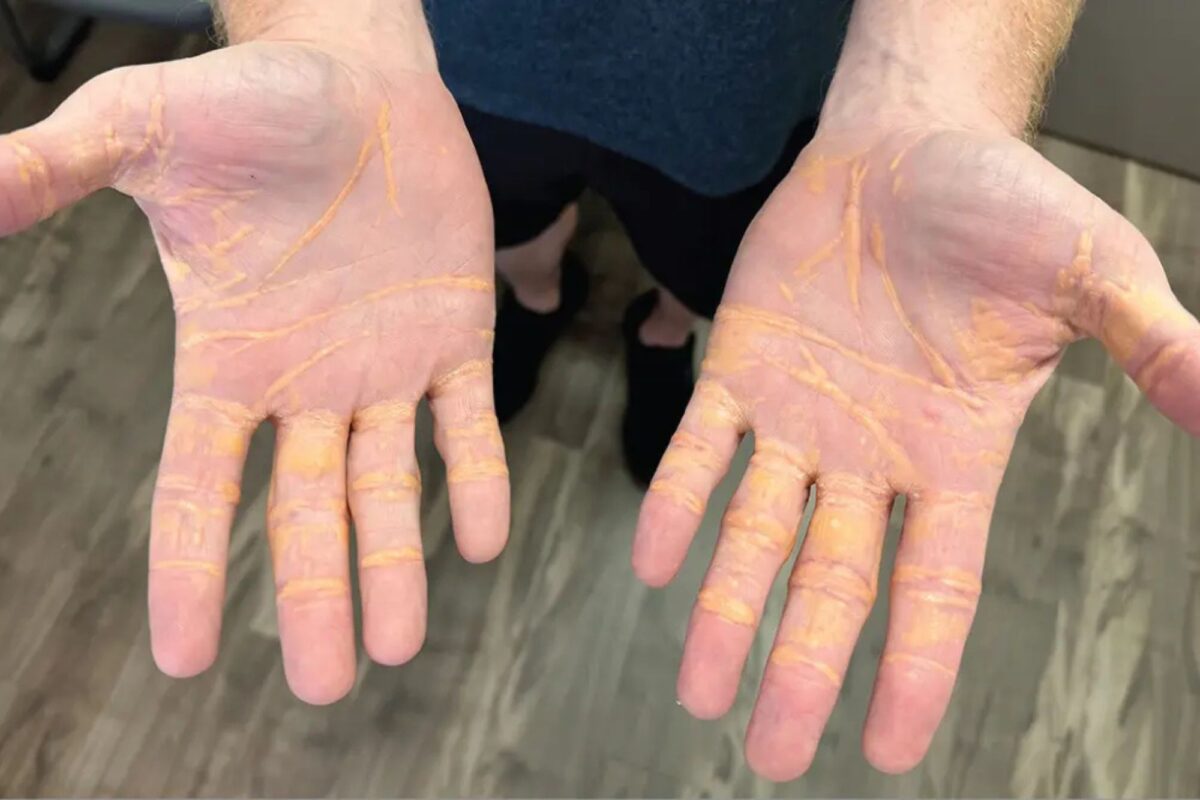 The man’s hands are seemingly yellow after eating butter, cheese and meat in a viral “carnivore diet”