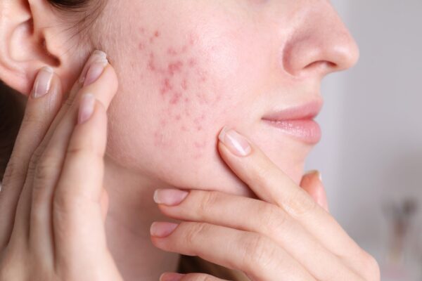 What causes acne to come back? A new study examines the effects of isotretinoin