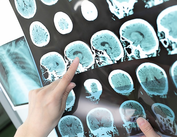 Teefs associated with long-term vascular damage and deterioration of stroke results