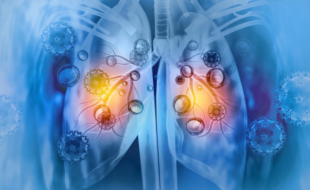 The breathing viruses arouse dormant breast cancer cells and increase the risk of recurrence