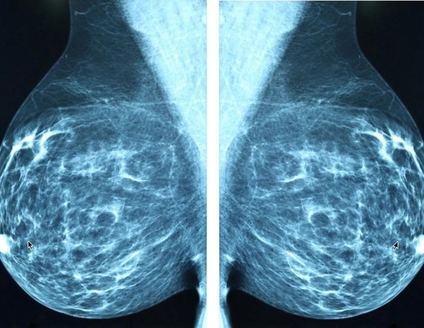 Mastectomy can contribute to worse sexual health, psychosocial results