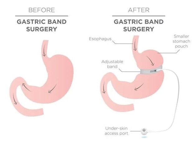 The study states that it will increase in the use of slimming drugs among patients with bariatric surgery