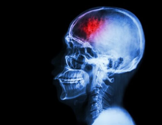 Disrupted brainstem-hippocampal connectivity identified as a biomarker of delirium